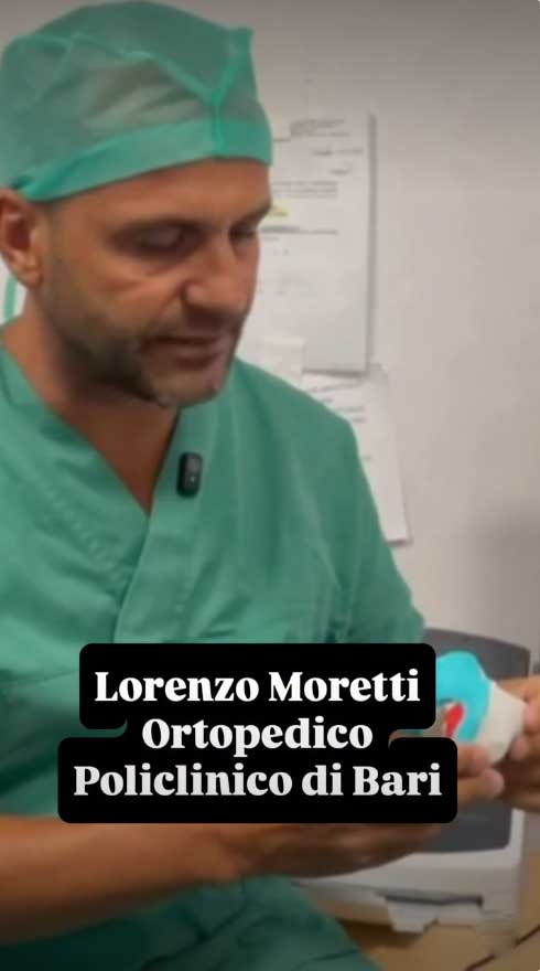 Policlinico di Bari: chirurgia biologica salva il ginocchio di una 43enne ed evita la protesi metallica